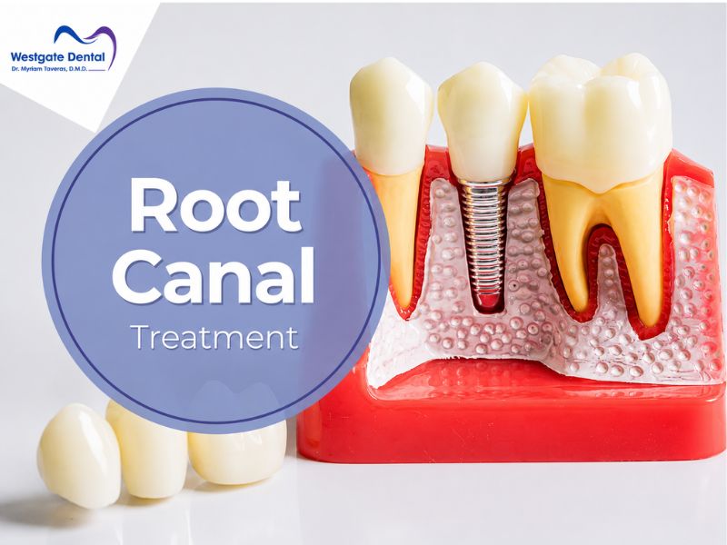 Root Canal - Image 1